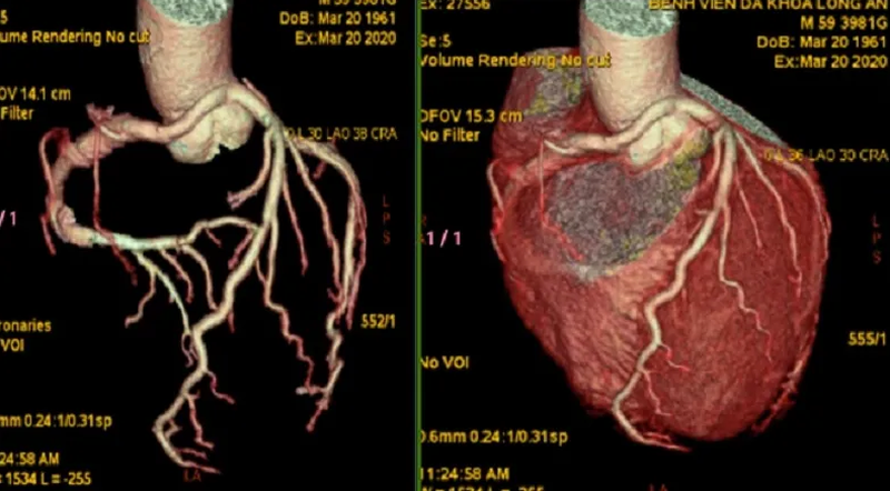 Chụp CT tim là gì? Chi phí chụp CT tim là bao nhiêu? 1