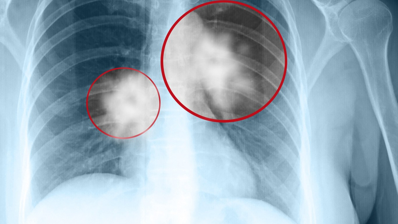 Chụp CT u phổi và quy trình thực hiện cơ bản 1