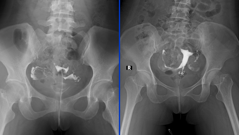 Chụp HSG là gì? Tìm hiểu về quy trình thực hiện, lợi ích và rui ro khi chụp HSG 1