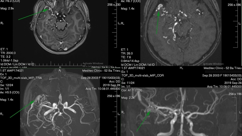 Chụp mạch máu: Tổng hợp 3 phương pháp hiệu quả hiện nay 2