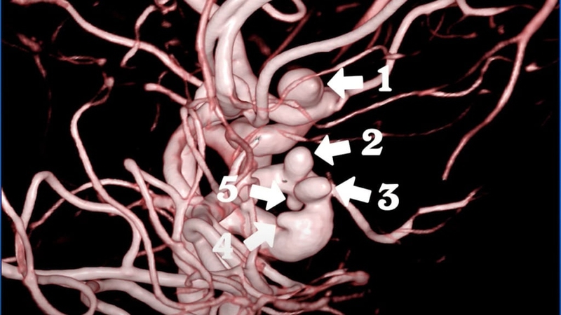 Chụp mạch máu: Tổng hợp 3 phương pháp hiệu quả hiện nay 3