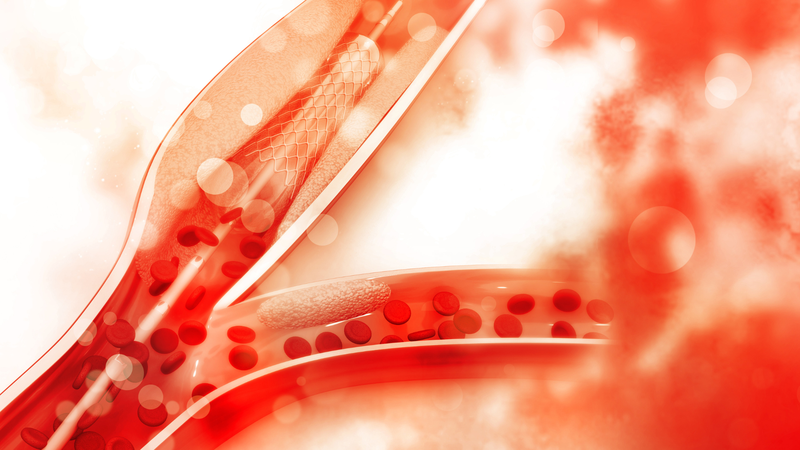 Chụp mạch vành sau đó cho thấy hai nhánh mạch vành chính bị hẹp tới 99%