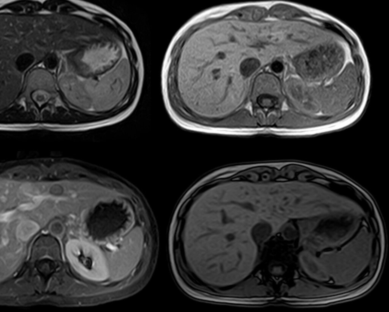 Chụp MRI gan: Vai trò, ưu điểm, nhược điểm và quy trình thực hiện 2