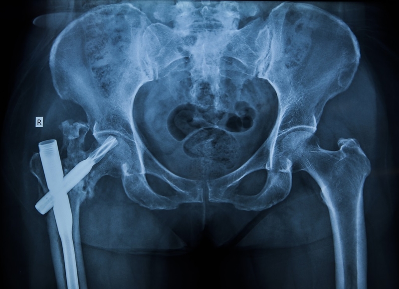 Chụp MRI khớp háng: Quy trình và chỉ định chụp cộng hưởng từ 3