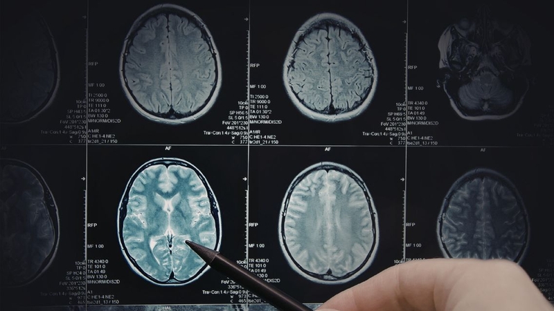 Máy chụp MRI hiện đại sử dụng từ trường mạnh để khảo sát cấu trúc não bộ