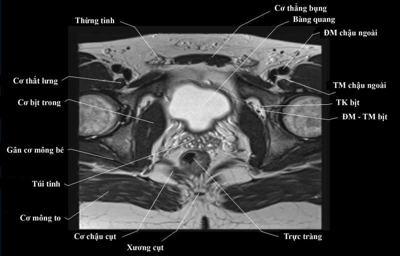 Chụp MRI tiểu khung là gì? Vai trò của chụp MRI tiểu khung ra sao? 1