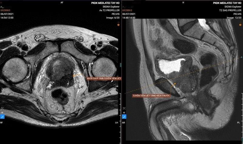 Chụp MRI tiểu khung là gì? Vai trò của chụp MRI tiểu khung ra sao? 3