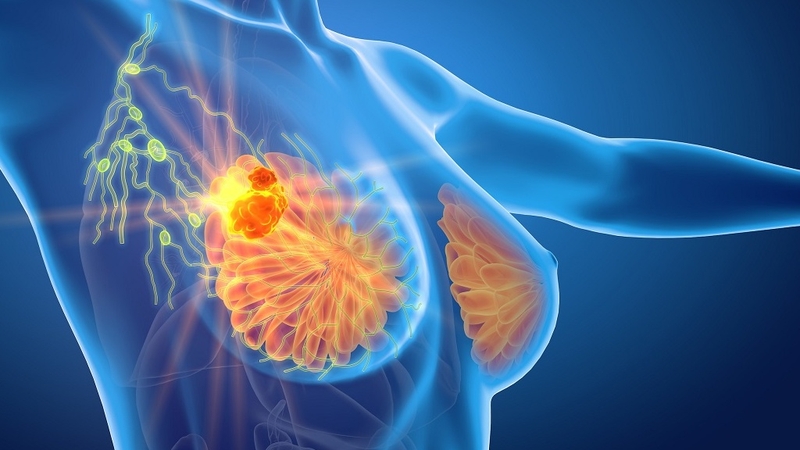 chụp nhũ ảnh - phương pháp tầm soát và chẩn đoán ung thư vú 2