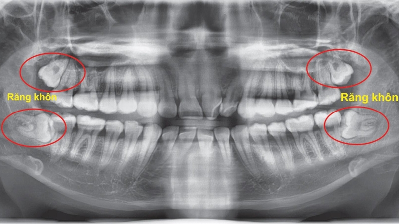 Chụp panorama răng 2