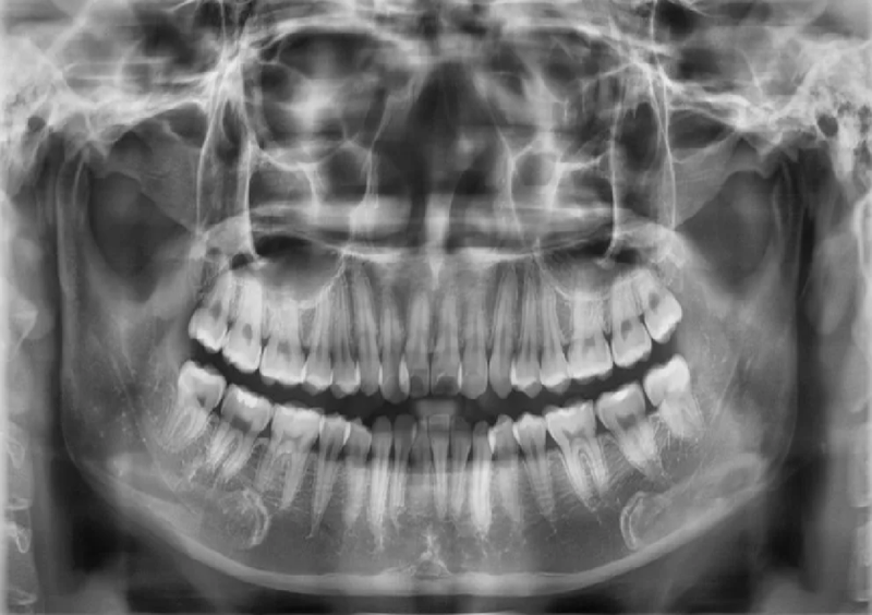 Chụp phim CT cone beam cho kết quả chính xác và đầy đủ nhất 1