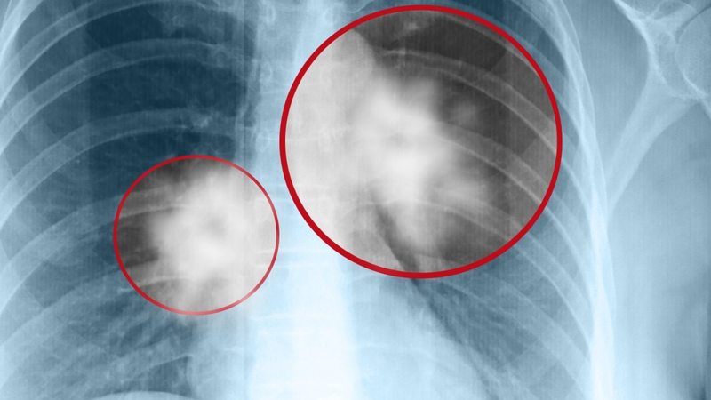 Chụp X quang có gây ung thư không? Tác động của tia X và biện pháp bảo vệ sức khỏe 1