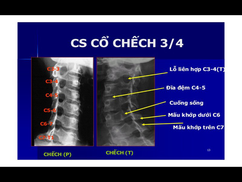 Chụp X quang cột sống cổ chếch 3/4 quy trình như thế nào?