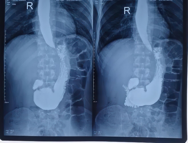 Chụp X quang dạ dày bao nhiêu tiền 4