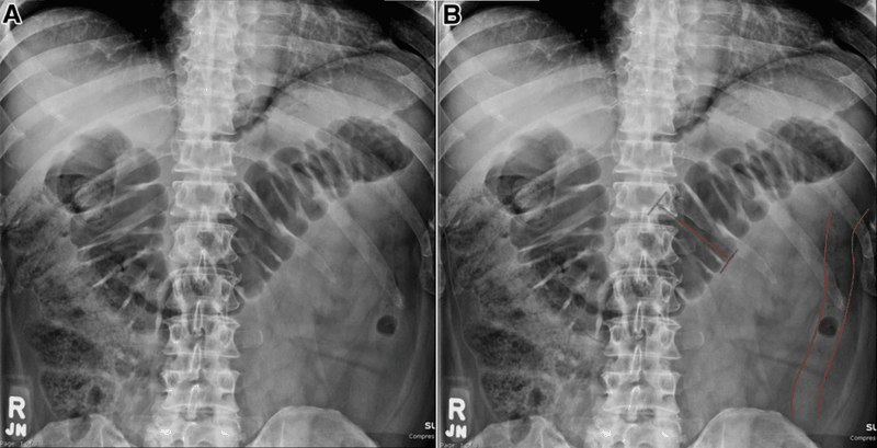 Chụp X quang tắc ruột là phương pháp gì?