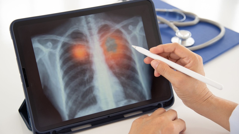 Chẩn đoán sớm giúp giảm đáng kể nguy cơ biến chứng và tử vong