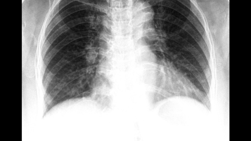 Chụp X quang viêm phổi do phế cầu giúp phân biệt viêm phổi do vi khuẩn với viêm phổi do virus