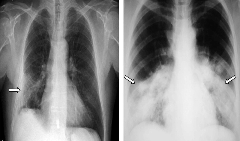 Chụp X-quang xơ phổi: Giải pháp chẩn đoán sớm những dấu hiệu bất thường về bệnh 1