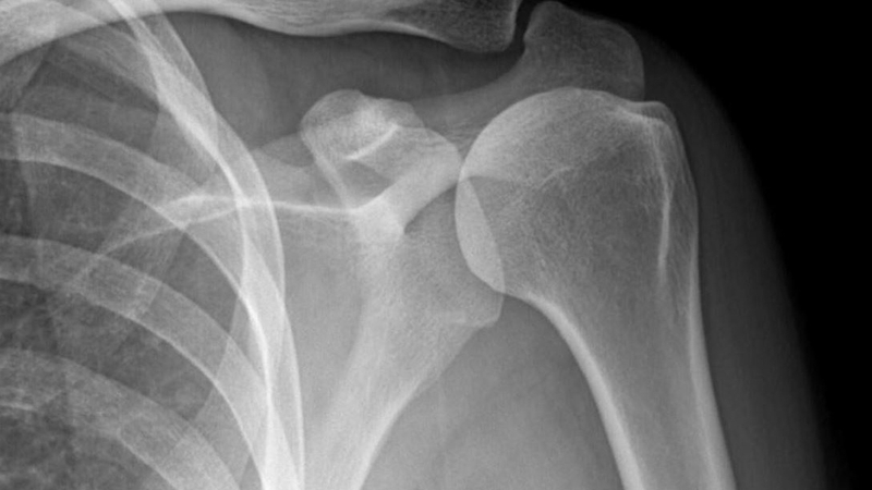 Chụp Xquang khớp vai phát hiện bệnh lý gì? Khi nào cần thực hiện? 1