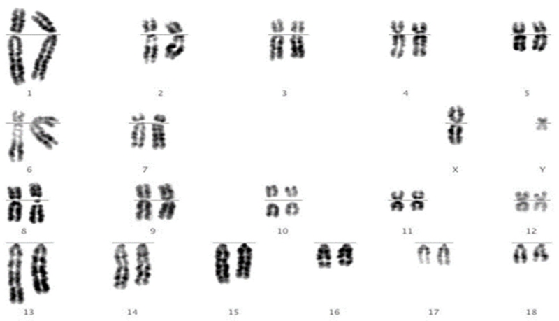 Chuyển đoạn Robertson gây ra những hậu quả gì? 1