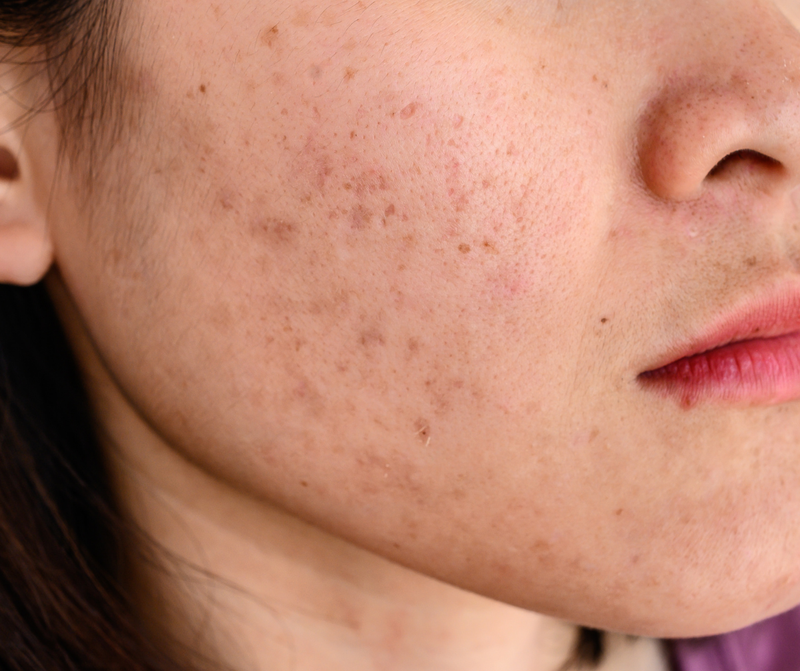 Chuyên gia giải đáp các vấn đề xoay quanh mặt tàn nhang 1