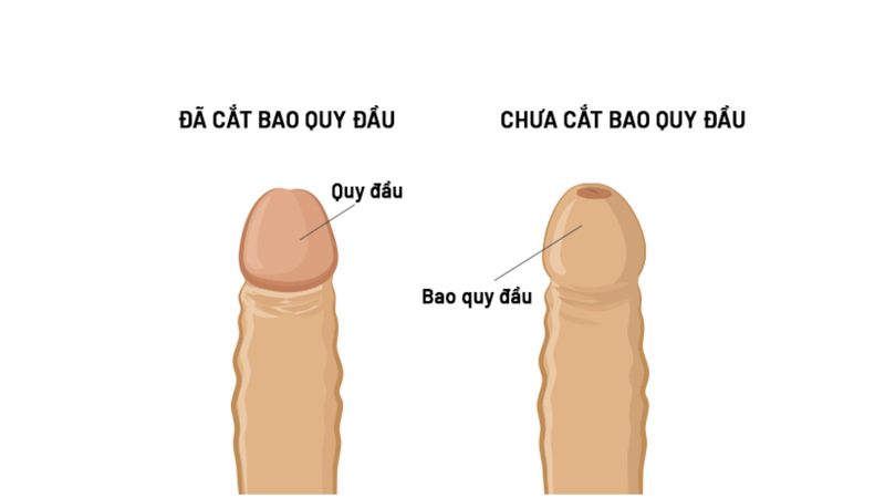 Circumcision là gì? Những lưu ý phục hồi sau khi thực hiện Circumcision 1