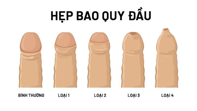 Circumcision là gì? Những lưu ý phục hồi sau khi thực hiện Circumcision 2