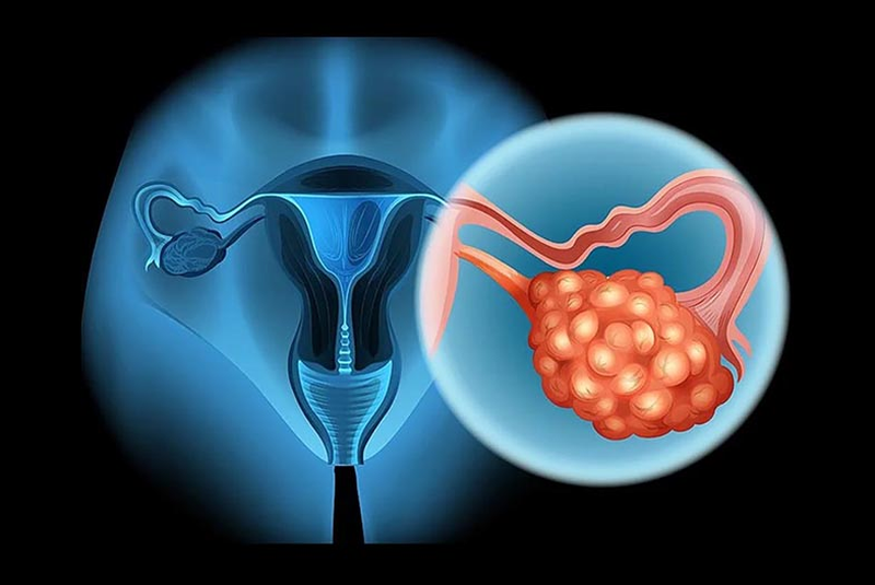 Có 3 nguyên nhân để biết đau bụng kinh có ảnh hưởng đến sinh sản không 3