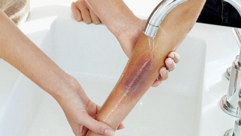 Có bao nhiêu cấp độ bỏng