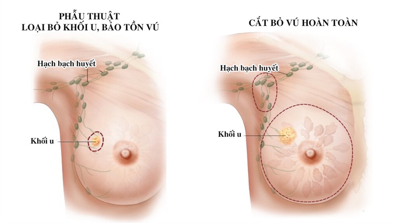Có bao nhiêu phương pháp phẫu thuật ung thư vú? 2