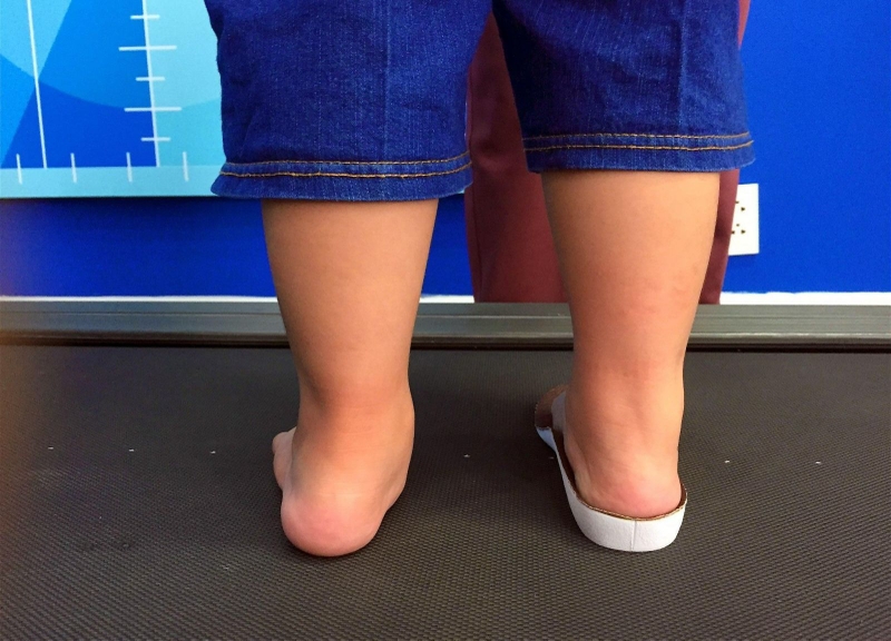 Có cần thiết phải phẫu thuật bàn chân bẹt không? 3