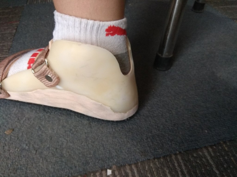 Có cần thiết phải phẫu thuật bàn chân bẹt không? 4