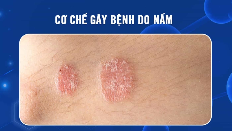 Cơ chế gây bệnh do nấm