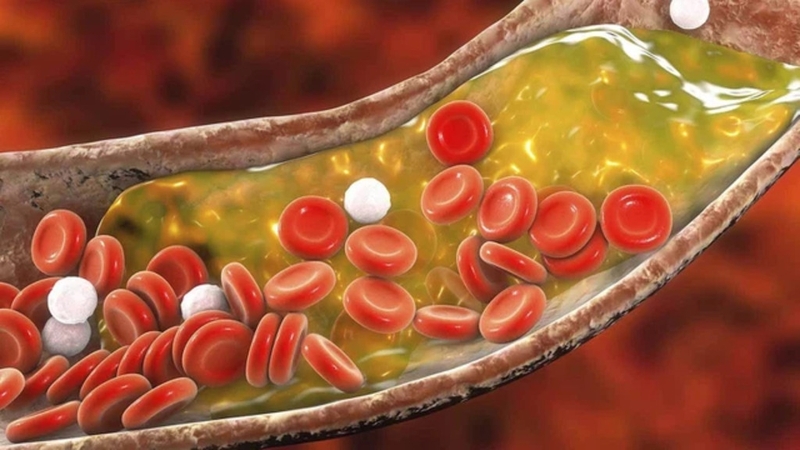 Cơ chế hình thành mảng xơ vữa và cách ngăn ngừa sự hình thành mảng xơ vữa 1