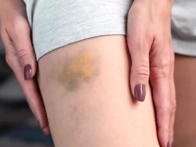 Co cơ: Triệu chứng, nguyên nhân và cách điều trị