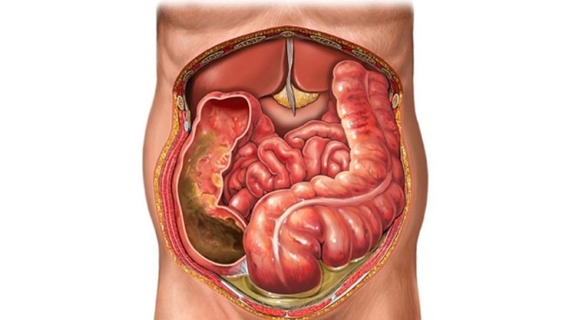 Co cứng thành bụng: Dấu hiệu không thể chủ quan! 1