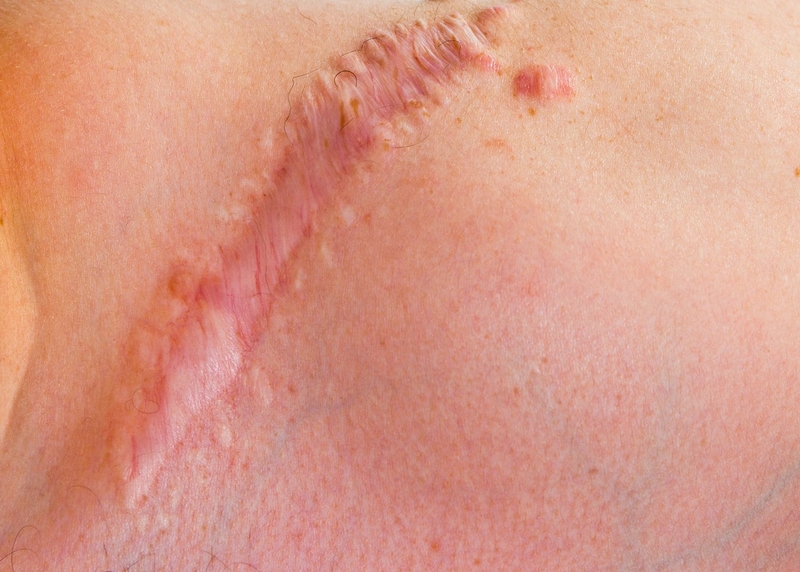 cơ địa sẹo lồi có xăm môi được không 1