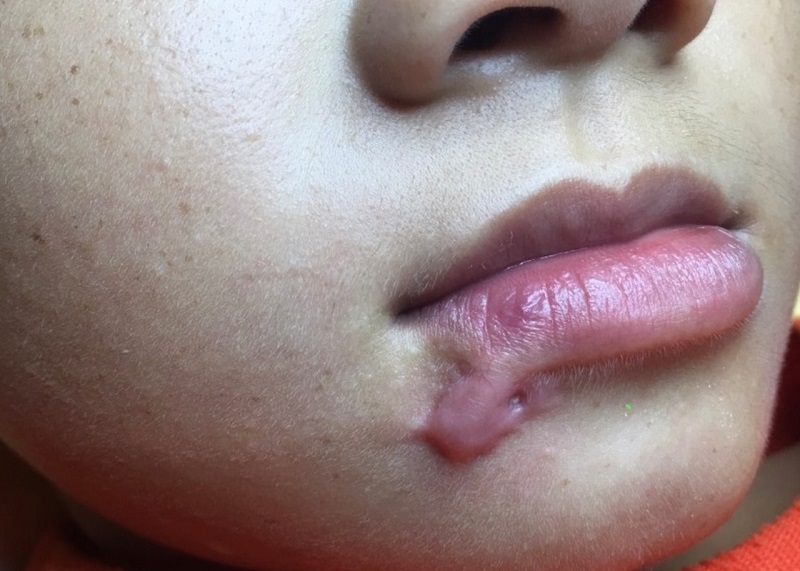 cơ địa sẹo lồi có xăm môi được không 3