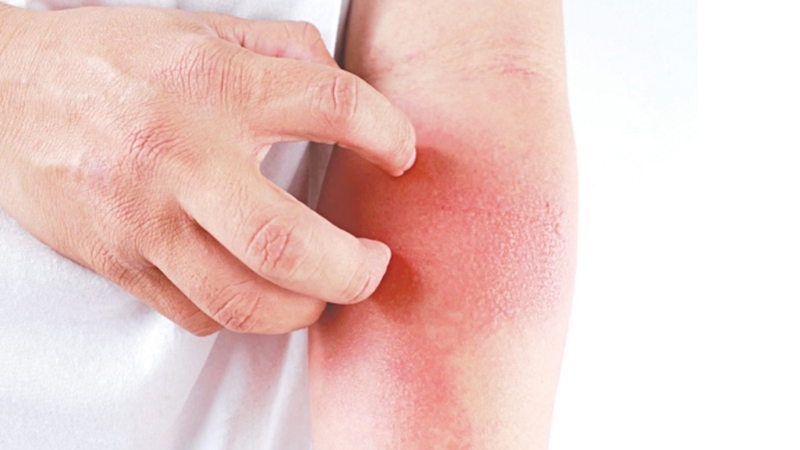 Cơ địa dị ứng là gì và nó có duy truyền không? 1