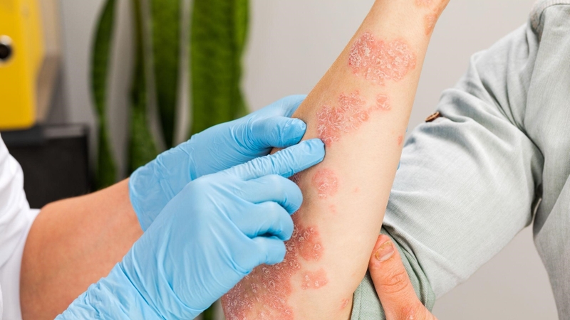 Cơ địa dị ứng là gì và nó có duy truyền không? 3