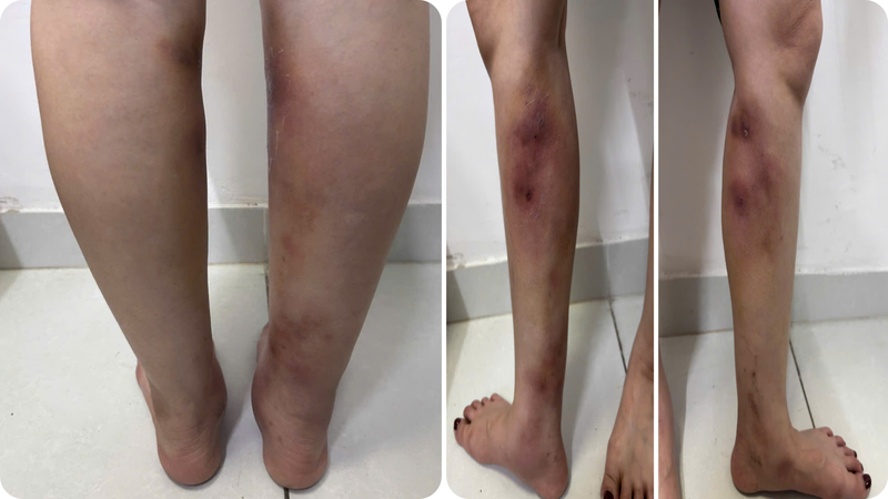 Hai cẳng chân bệnh nhân biến dạng rõ rệt, kèm theo nhiều khối sưng đỏ sau khi tiêm filler