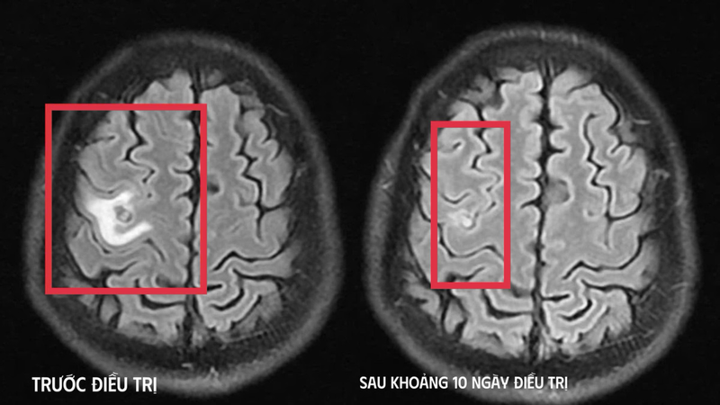 Hình ảnh MRI cho thấy tổn thương não do ký sinh trùng, không phải u não