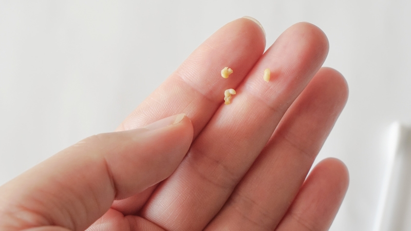 Cổ họng nổi hạt trắng xảy ra do nguyên nhân gì? 2