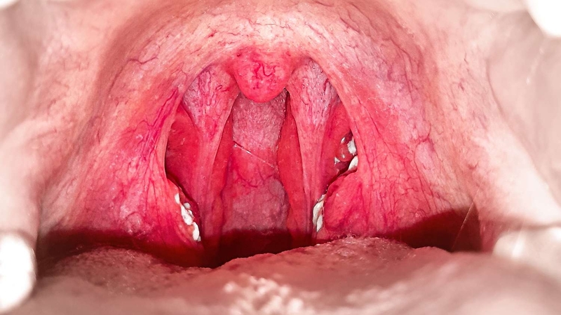 Cổ họng nổi nốt đỏ: Nguyên nhân, triệu chứng và cách điều trị 1