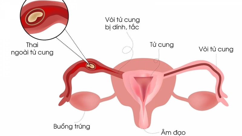 Có kinh sớm có phải mang thai không? Những dấu hiệu mang thai sớm dễ nhận biết nhất 2