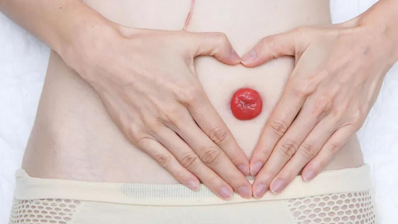 Có mấy loại hậu môn nhân tạo? Túi hậu môn nhân tạo loại nào tốt? 2