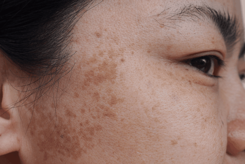 Có mấy loại nám da? Loại nào thường gặp nhất? 1