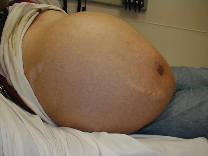 Có mối liên hệ nào giữa rượu bia và xơ gan cổ trướng?1