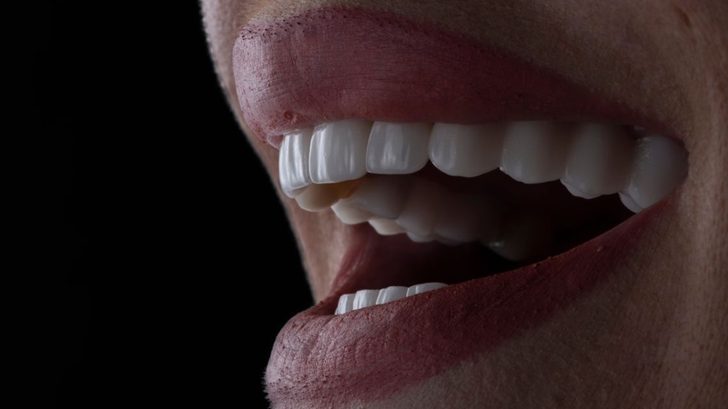 Có nên bọc răng sứ không? Ưu và nhược điểm bạn cần biết 2