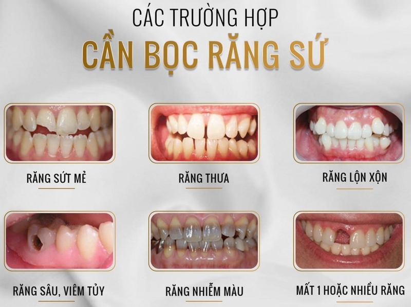 Có nên bọc răng sứ nguyên hàm hay không?-2