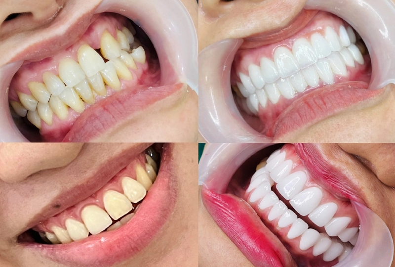 Có nên bọc răng sứ nguyên hàm hay không? -3